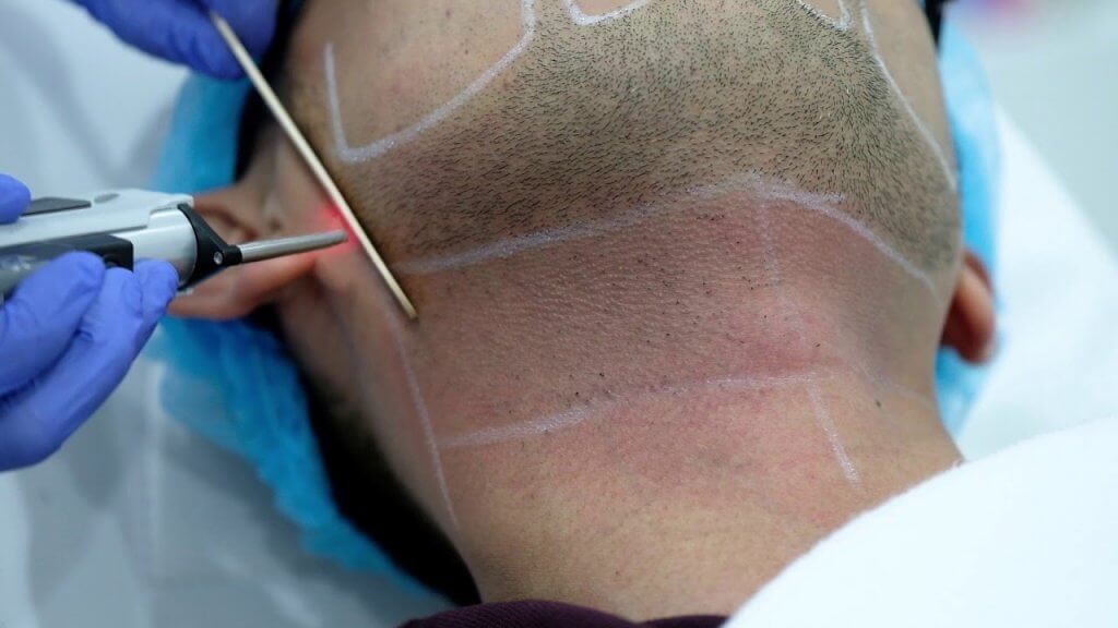 ZO Skin Centre - Laser Hair Removal - Beard Definition